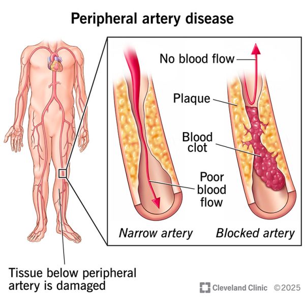 17357-peripheral-arterial-disease-illustration-2