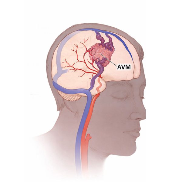 AVM
