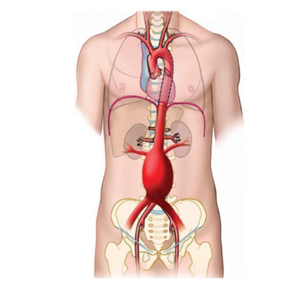Aortic Aneurysm