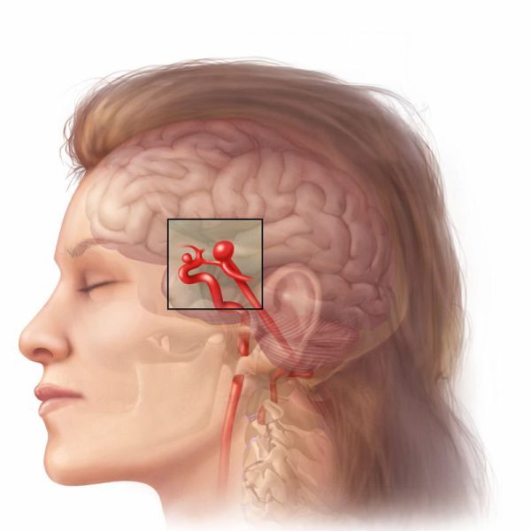 Brain Aneurysm