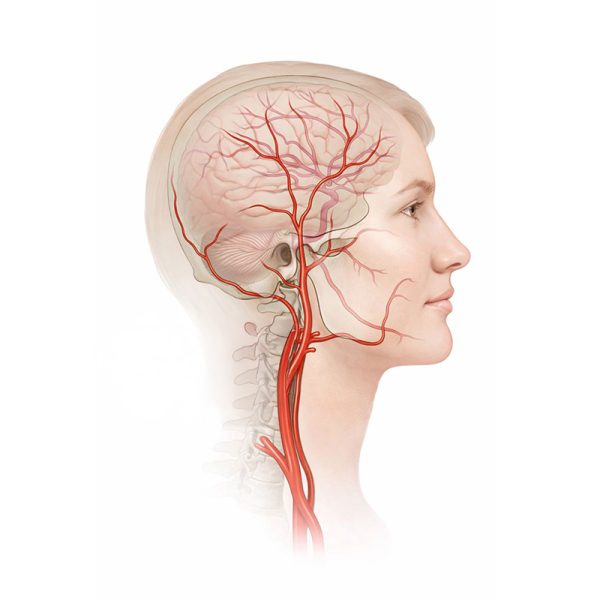 Carotid Artery Disease