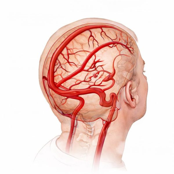 Cerebral Venous Thrombosis