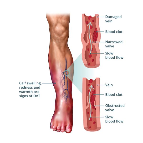 Venous DVT