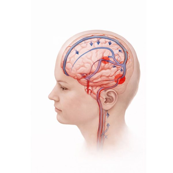 Idiopathic Intracranial Hypertension (IIH)