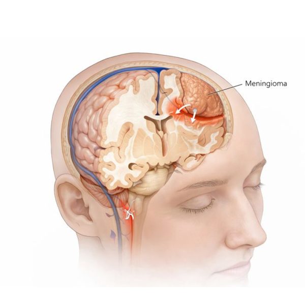 Brain Tumor Meningioma