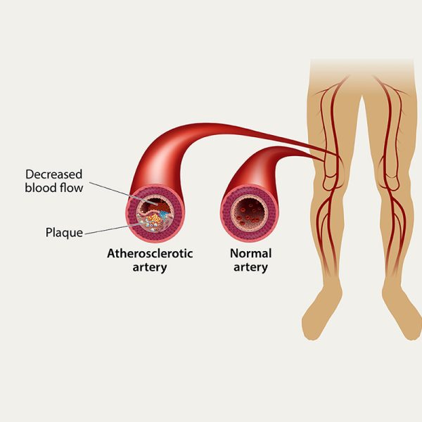 Peripheral Arterial Disease (PAD)