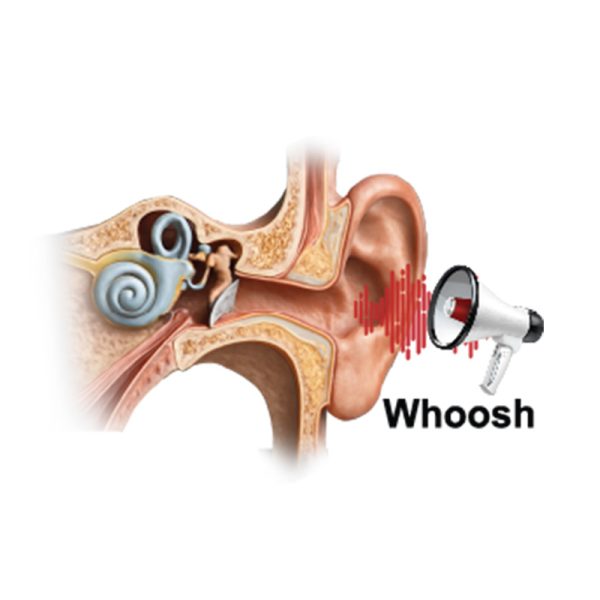 Pulsatile Tinnitus