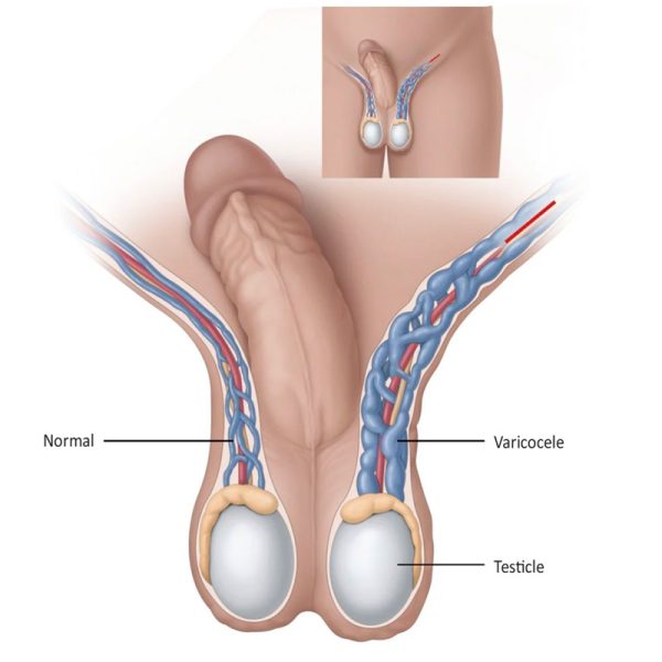 Venous Varicocele