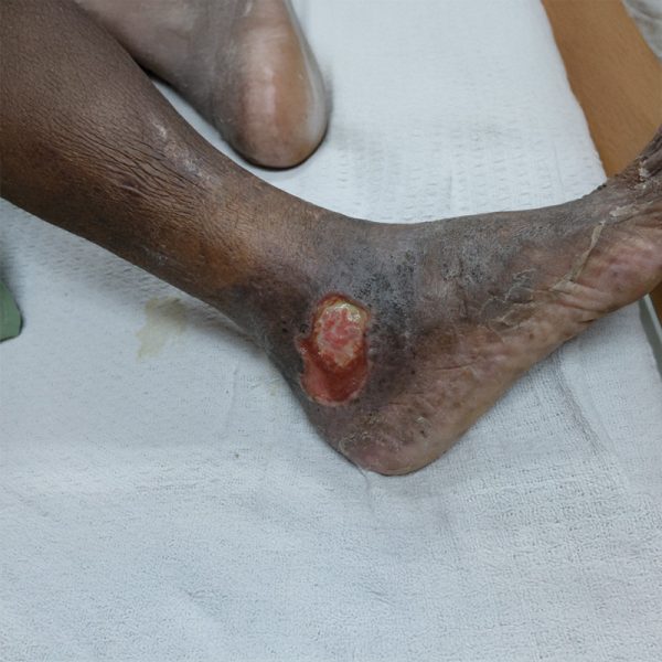 Venous Venous Ullcer